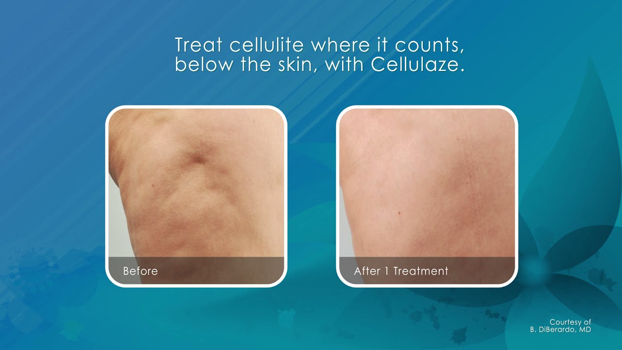 Cellulaze - Laser Cellulite Treatment