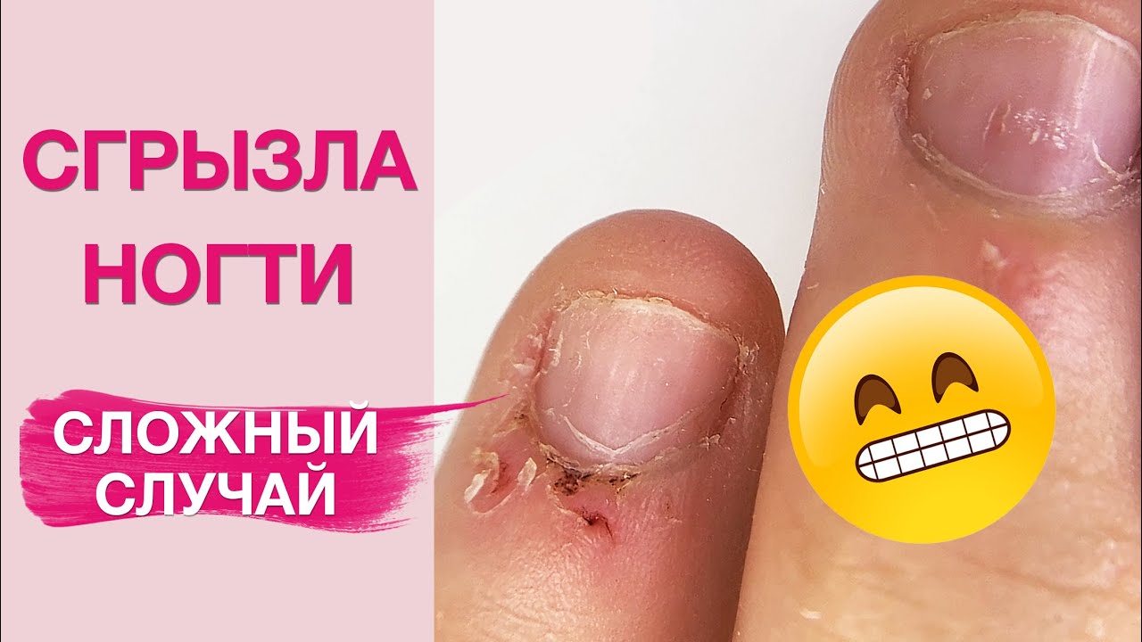 Заусенцы! Как НЕ грызть ногти? Наращивание БЕЗ форм