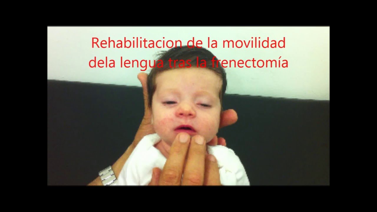 Ejercicios Rehabilitacion Post Frenectomia