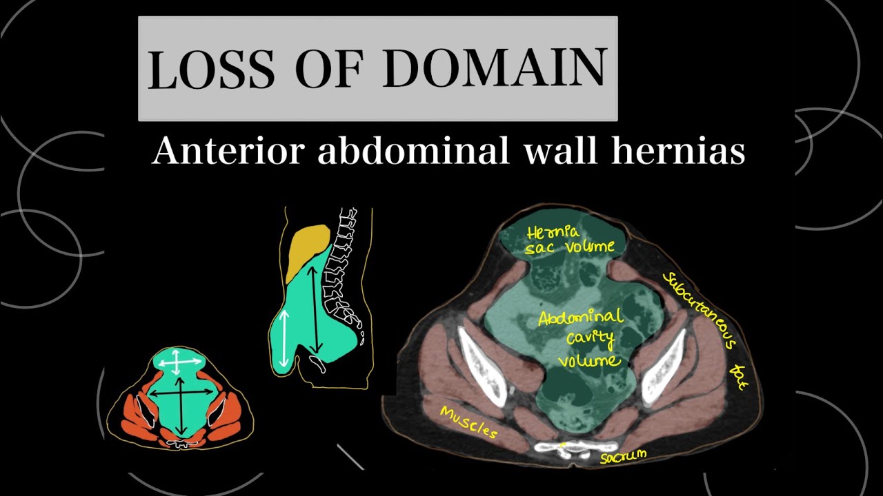 LOSS OF DOMAIN CALCULATION for abdominal wall hernias on CT scan.  SABBAGH and TANAKA methods.