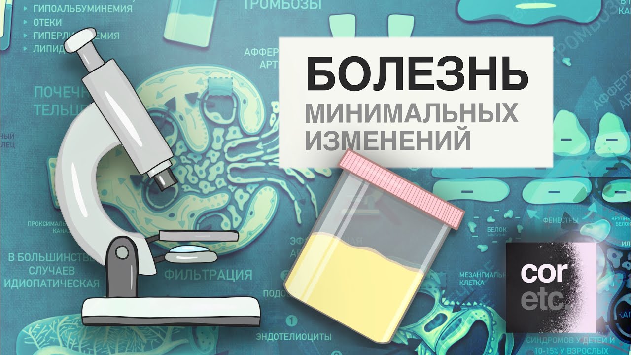 Болезнь минимальных изменений. Нефротический синдром.