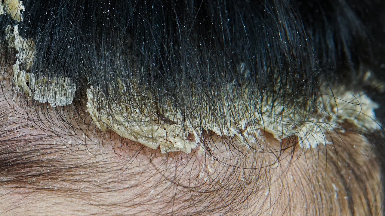 ASMR Satisfying Dandruff Treatment & Scalp Check #0007