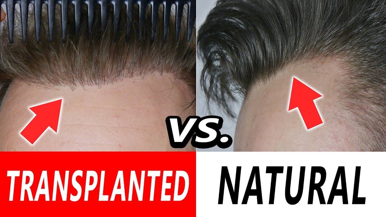 TRANSPLANTED vs. NATURAL HAIRLINE!!! Can you see the difference?