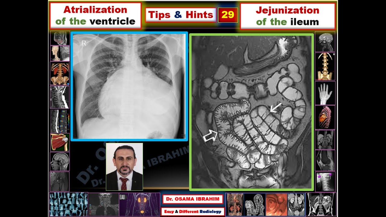 Tips & Hints 29 Jejunization of the ileum/ Atrialization of the ventricle