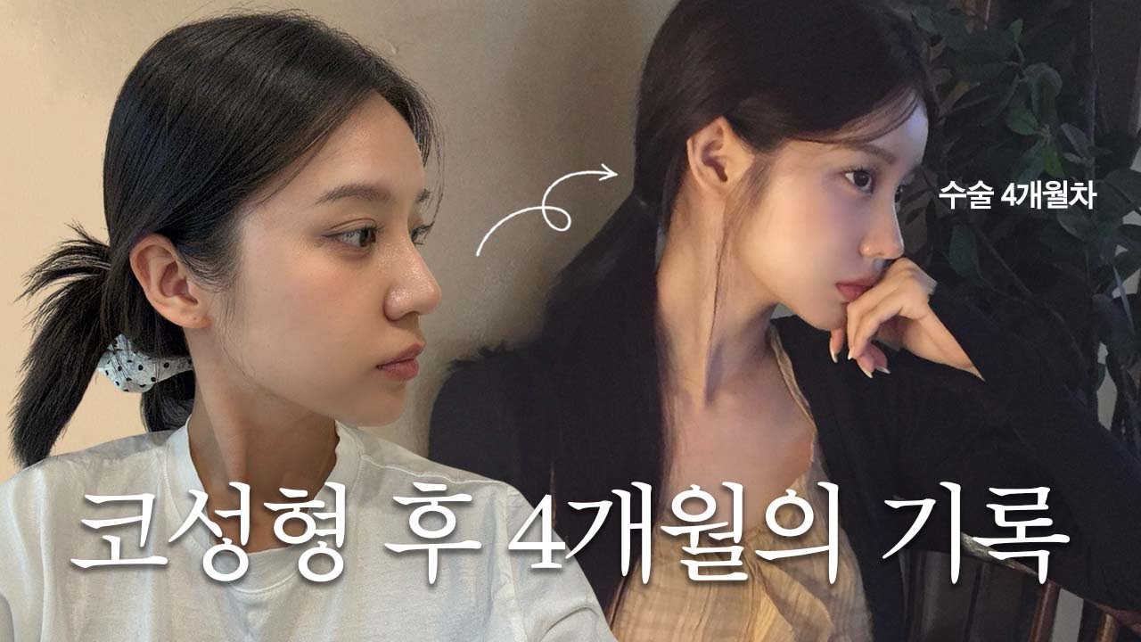 [VLOG] 코수술 후기 브이로그 4개월간의 기록