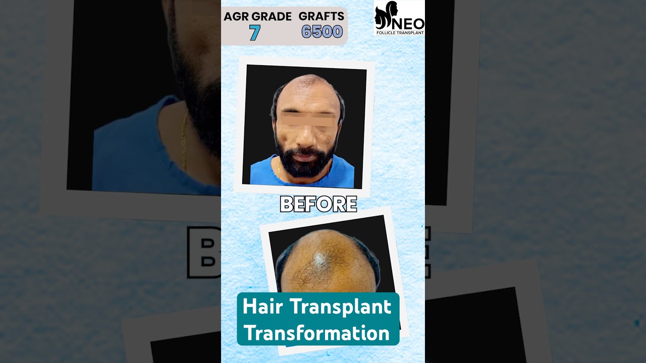 Grade 7 Hair Loss | 6-Month Progress of Hair Transplant at Neo Follicle Transplant clinic, Bengaluru