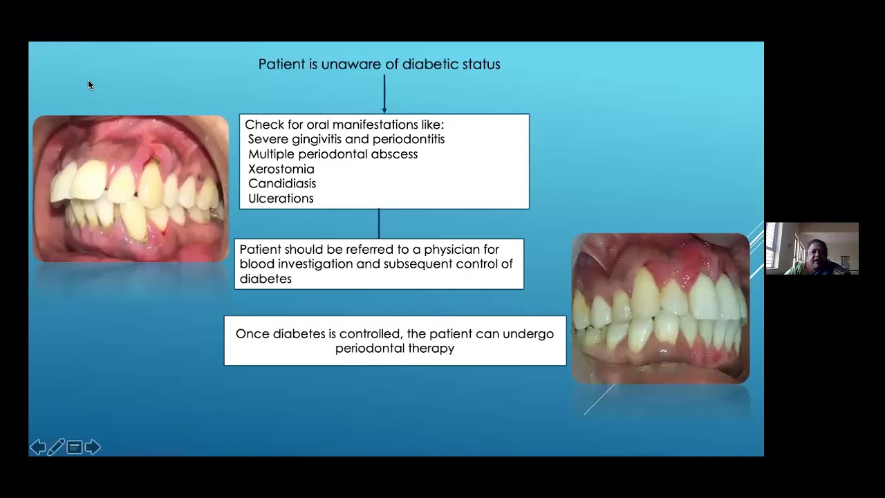 Periodontal Management of Oral Diabetes