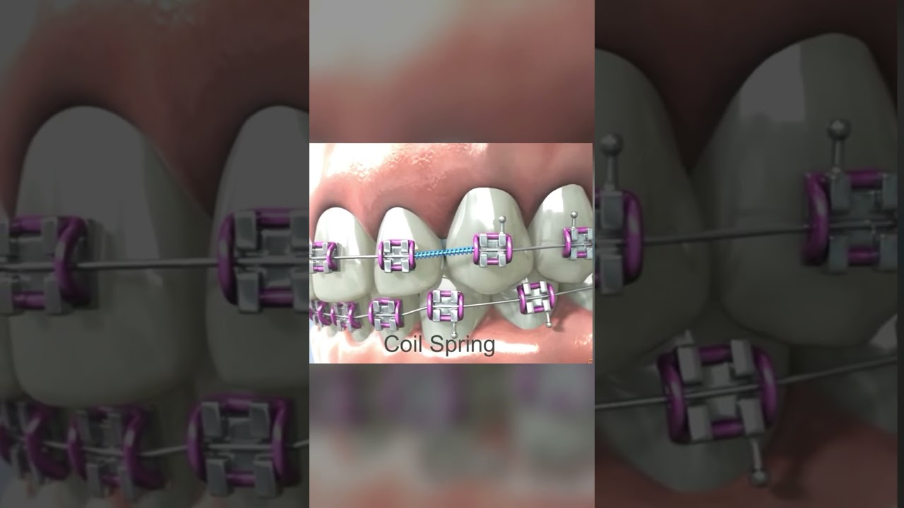 How a coil spring opens space in between teeth !! #braces #orthodontics #dentist #teeth