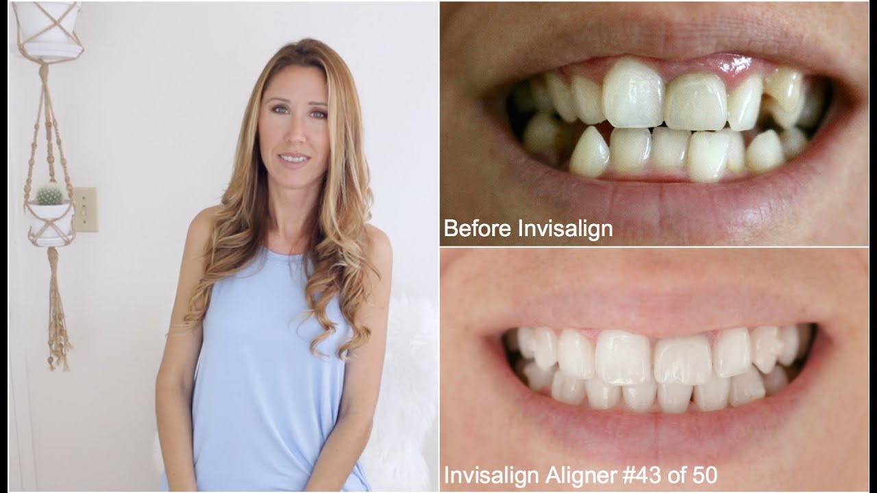 Invisalign Update #4 | Progress Pics | Elastics