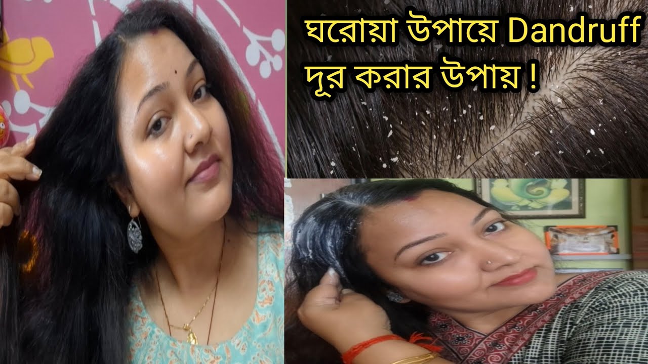 ঘরোয়া উপায়ে Dandruff দূর করার উপায় !|Home Remedies for Dandruff!