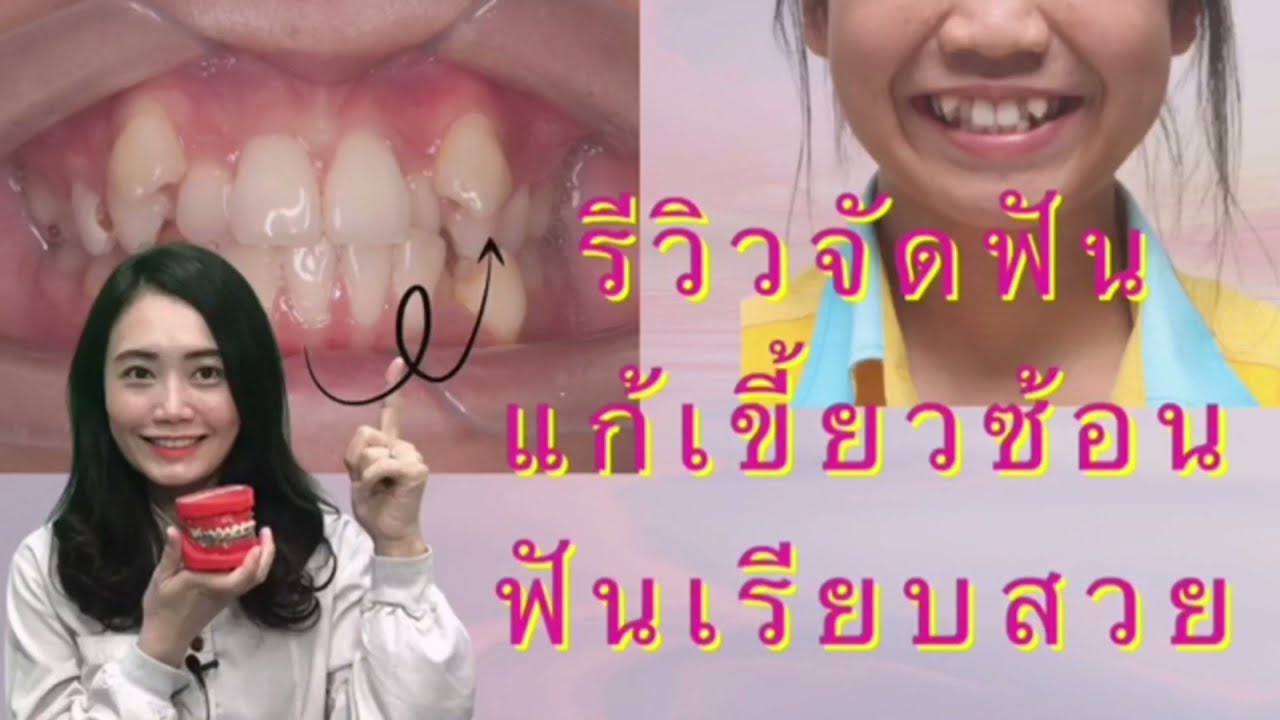 รีวิวจัดฟันแก้ฟันเขี้ยวซ้อนให้ฟันเรียบสวย/dental point pattaya /โดยหมอหลิน