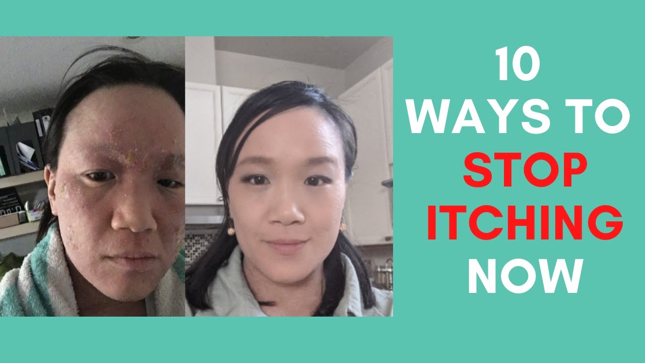 10 ways to stop itching now if you have eczema or TSW (topical steroid withdrawal)
