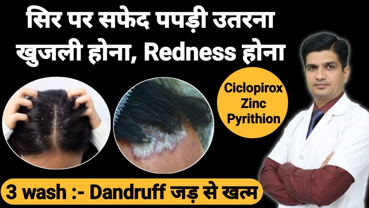 सिर और बालो से जुडी ये समस्याए तुरंत घायब । Best Dandruff shampoo
