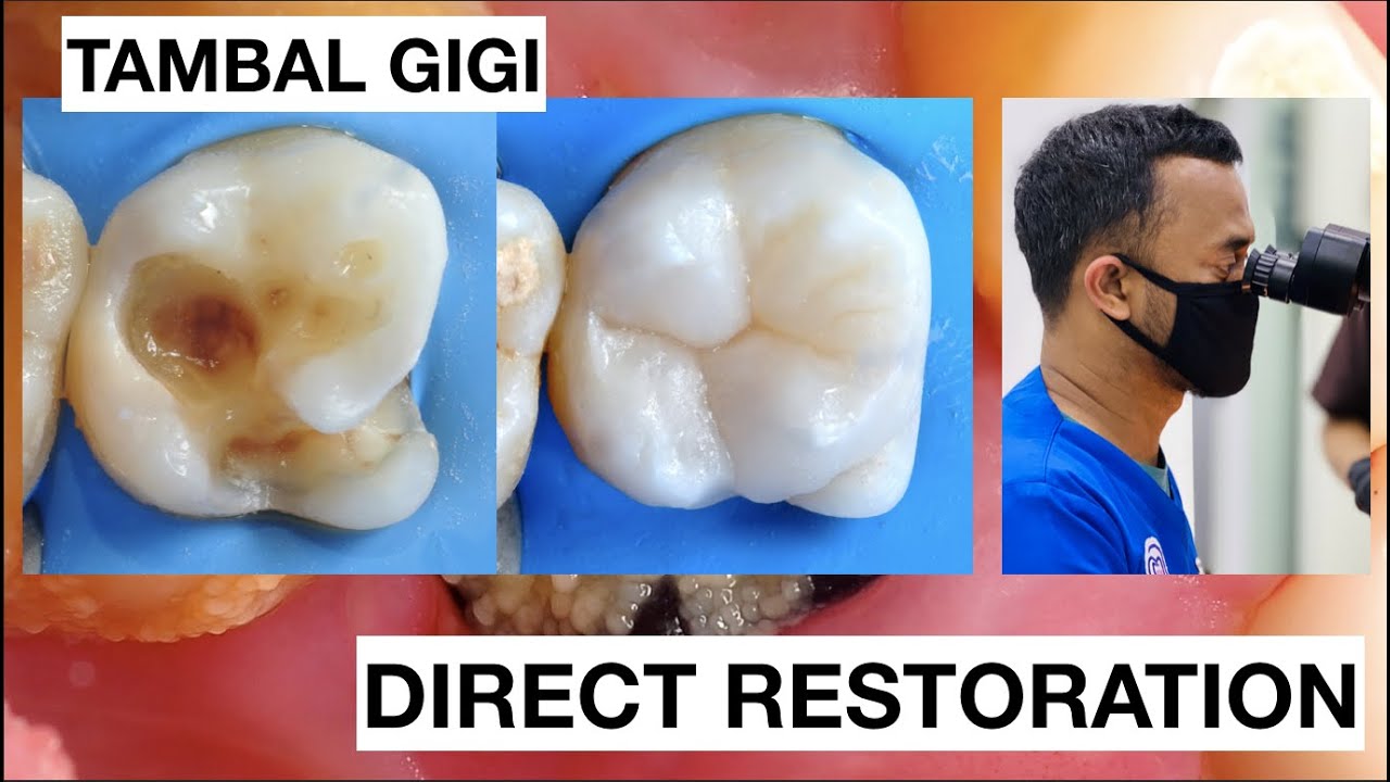Step by step Dental Filling Composite Molar Direct Restoration Dentist Griya RR