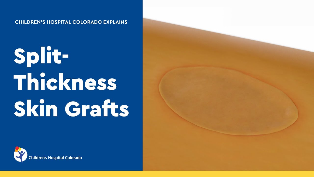 Split-Thickness Skin Graft