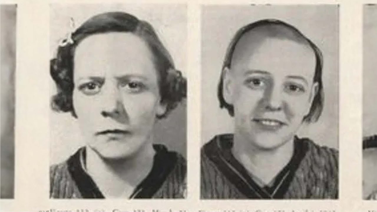 Безумное увлечение лоботомией в 1950-х годах