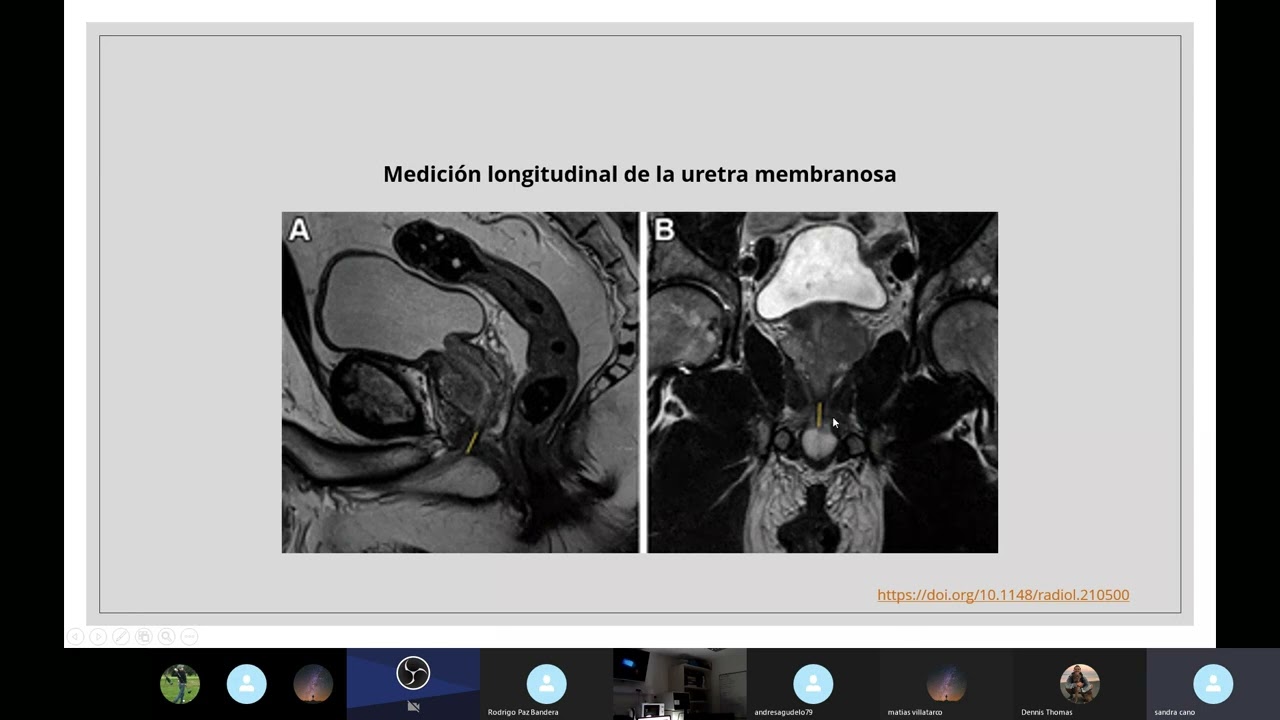 Incontinencia Urinaria post Prostatectomía Radical  evaluación por MR