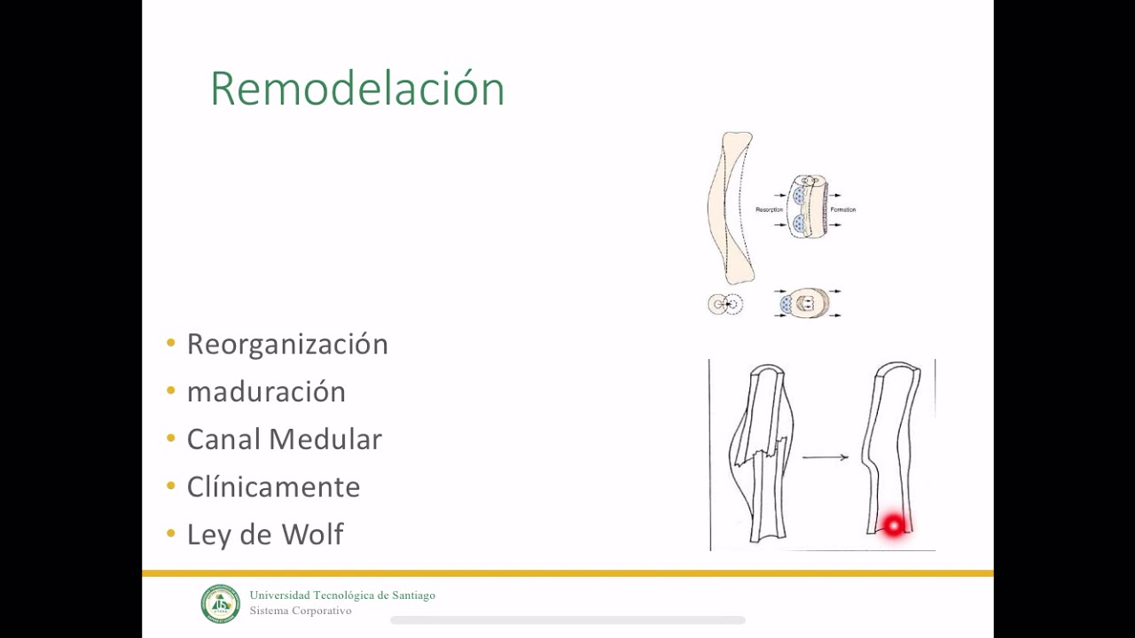 consolidacion de las fracturas y no union