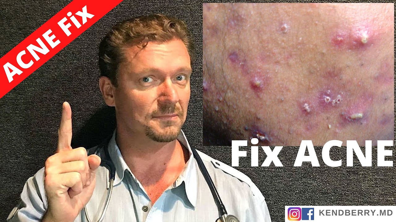 BAD ACNE? (Avoid these Foods!!!) 2024