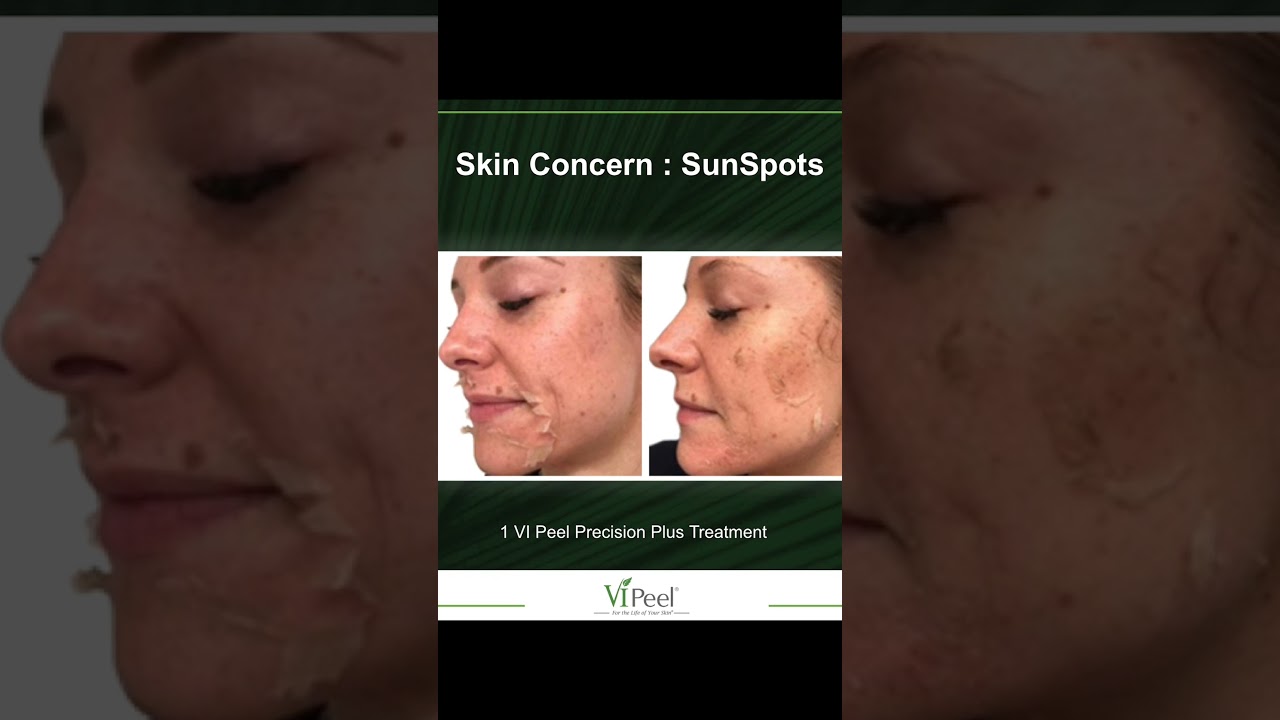 VI Peel Sun Spots Before & After Images At Beverly Hills Wellness Center & Med Spa, Florida #shorts