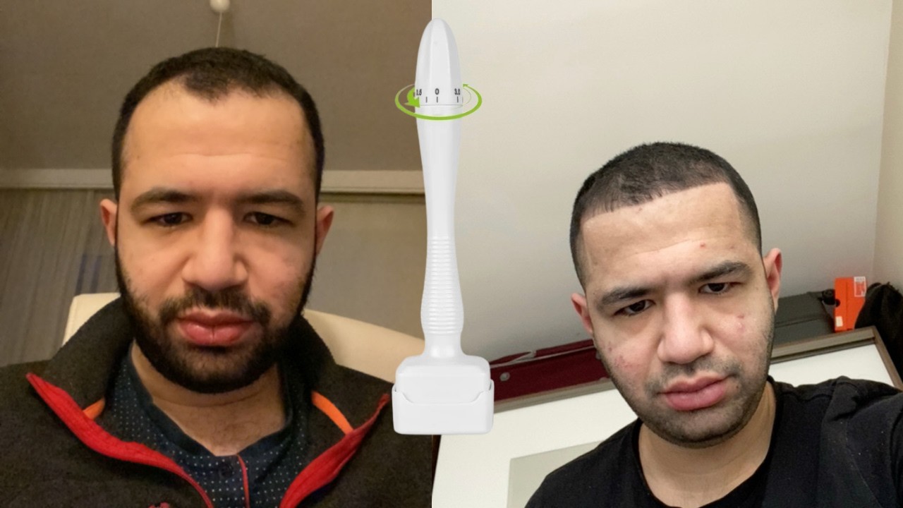 Dermastamp vs Dermaroller: Saç İçin Hangisi Daha Mantıklı?