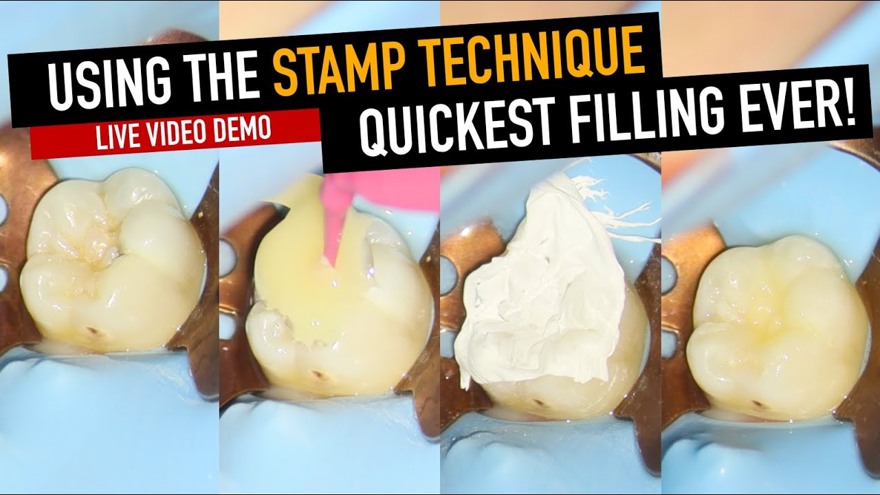 QUICKEST DENTAL FILLING - THE STAMP TECHNIQUE | 4K Resolution