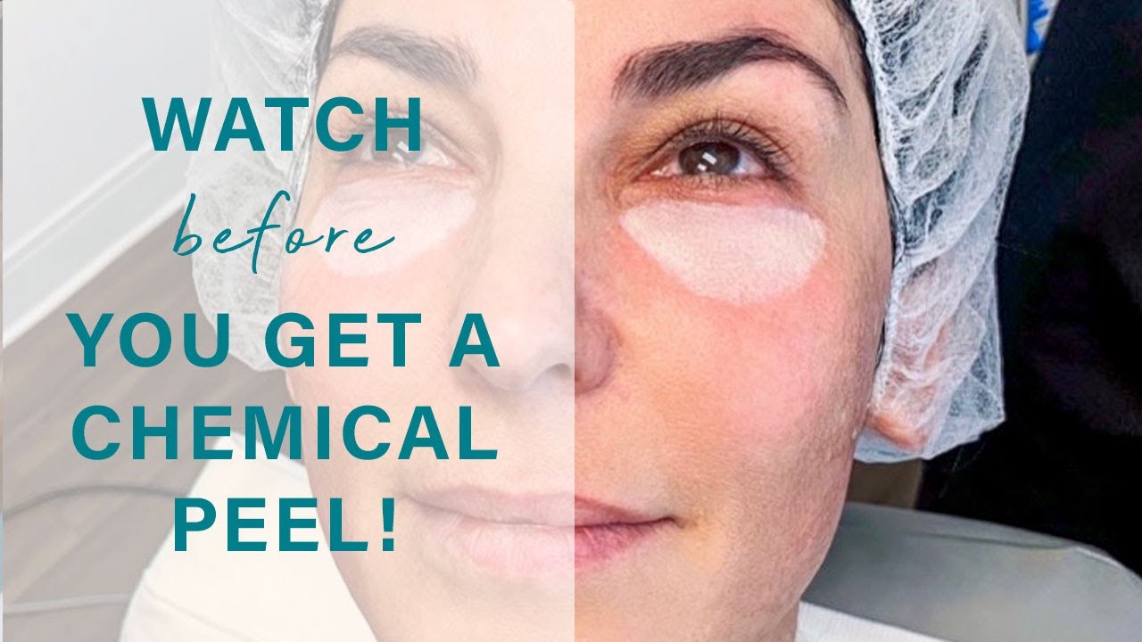 Under-Eye Chemical Peel | Board Certified Facial Plastic Surgeon