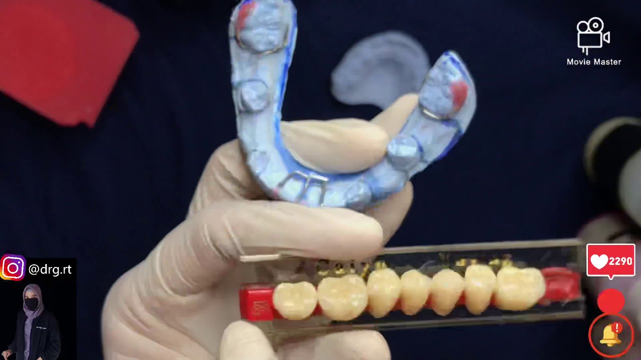 REMOVABLE FUNCTIONAL SPACE MAINTAINER | By Dokter Gigi Ratna Tarihoran | FULL VIDEO