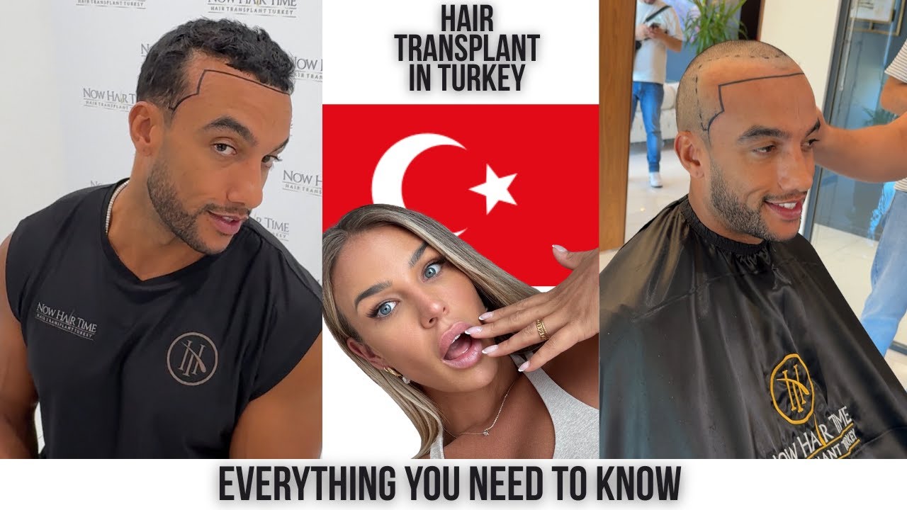 Пересадка волос в Турции 🇹🇷 (2025) | Чего ожидать и безопасно ли это?