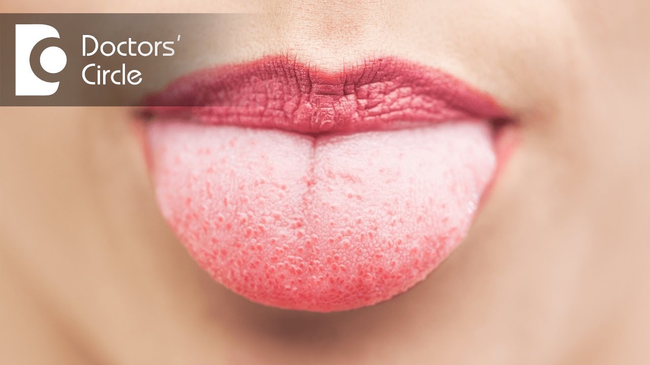 How to get rid of Swollen Taste Buds? - Dr. Maneesh Chandra Sharma