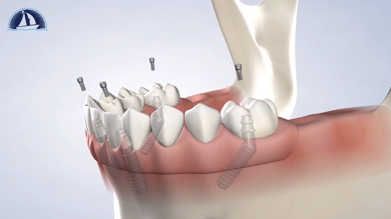 Full-Arch Restoration at Rockwall Oral Surgery