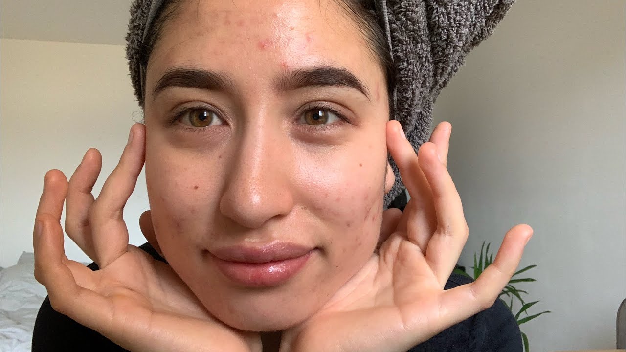 ZWEI Monate ISOTRETINOIN 💓Aknenormin Therapie Videotagebuch 📔❤️ - Keine neuen Pickel/ Knoten mehr!