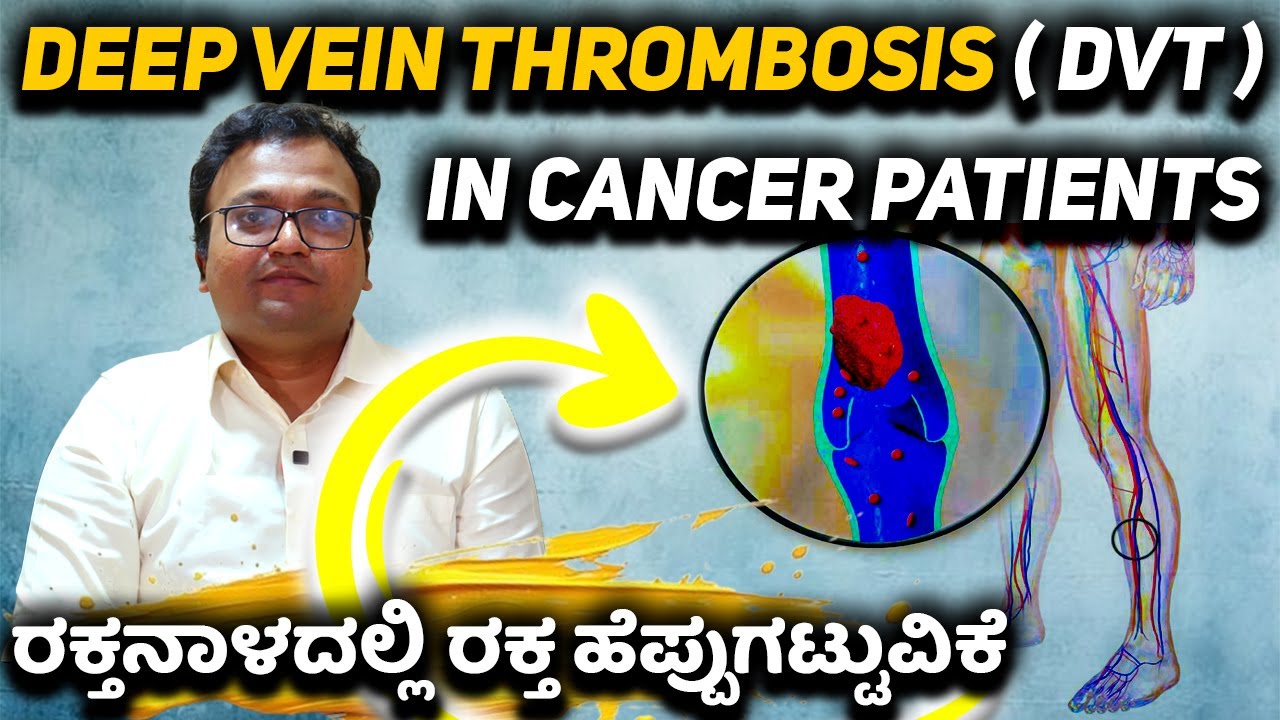 Deep vein thrombosis ( DVT ) in Cancer Patients ರಕ್ತನಾಳದಲ್ಲಿ ರಕ್ತ ಹೆಪ್ಪುಗಟ್ಟುವಿಕೆ
