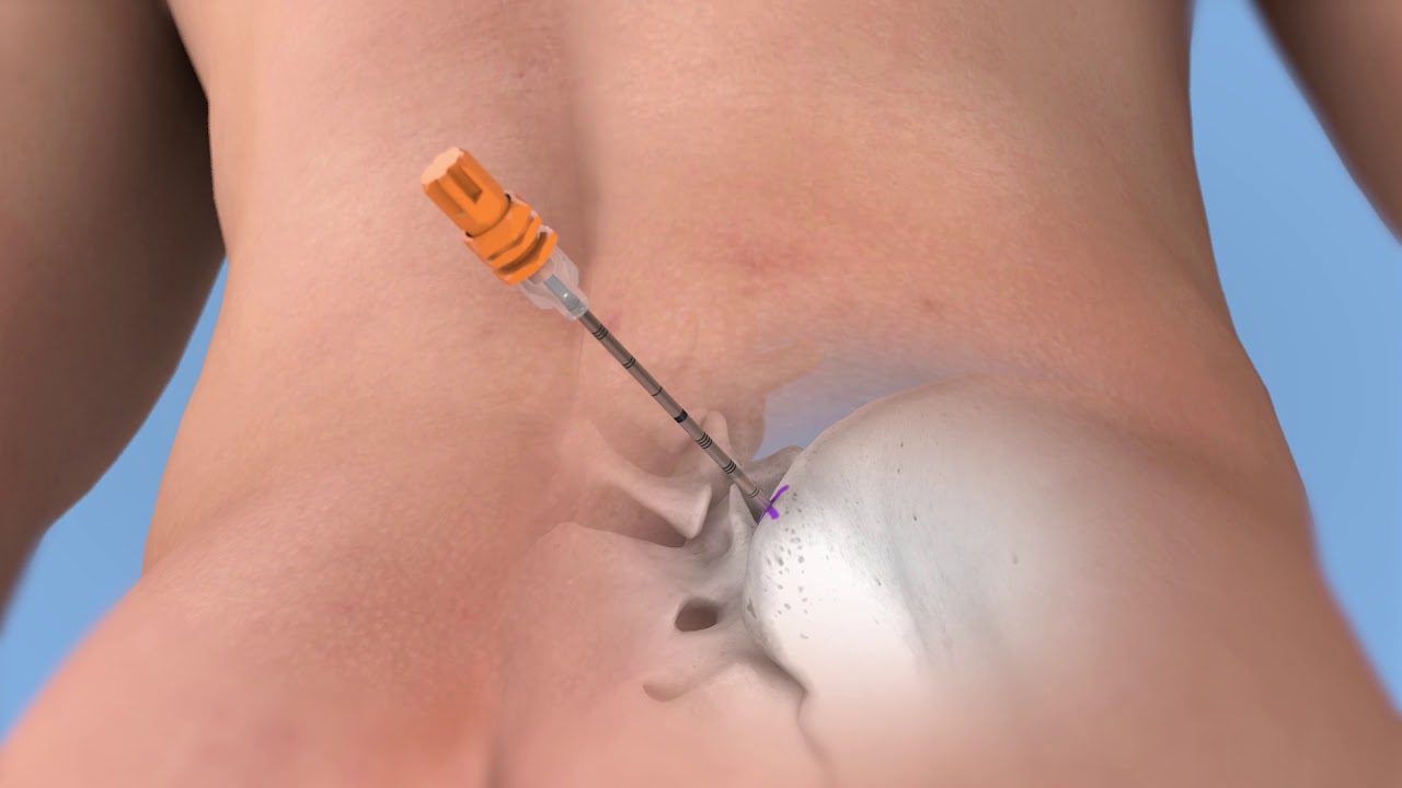 Arrow&trade; OnControl&trade; Powered Bone Access System-Bone Marrow Biopsy and Aspiration