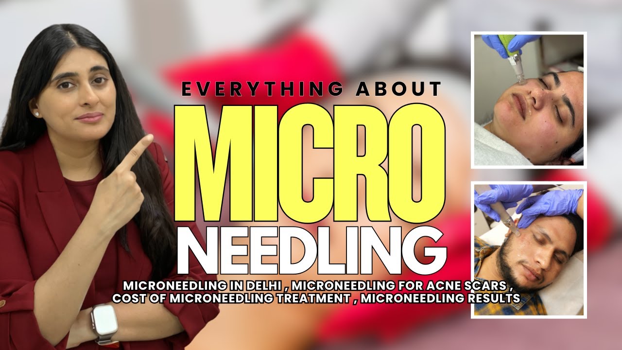 Microneedling Treatment in Delhi | Microneedling Cost in India | Microneedling for Acne Scars