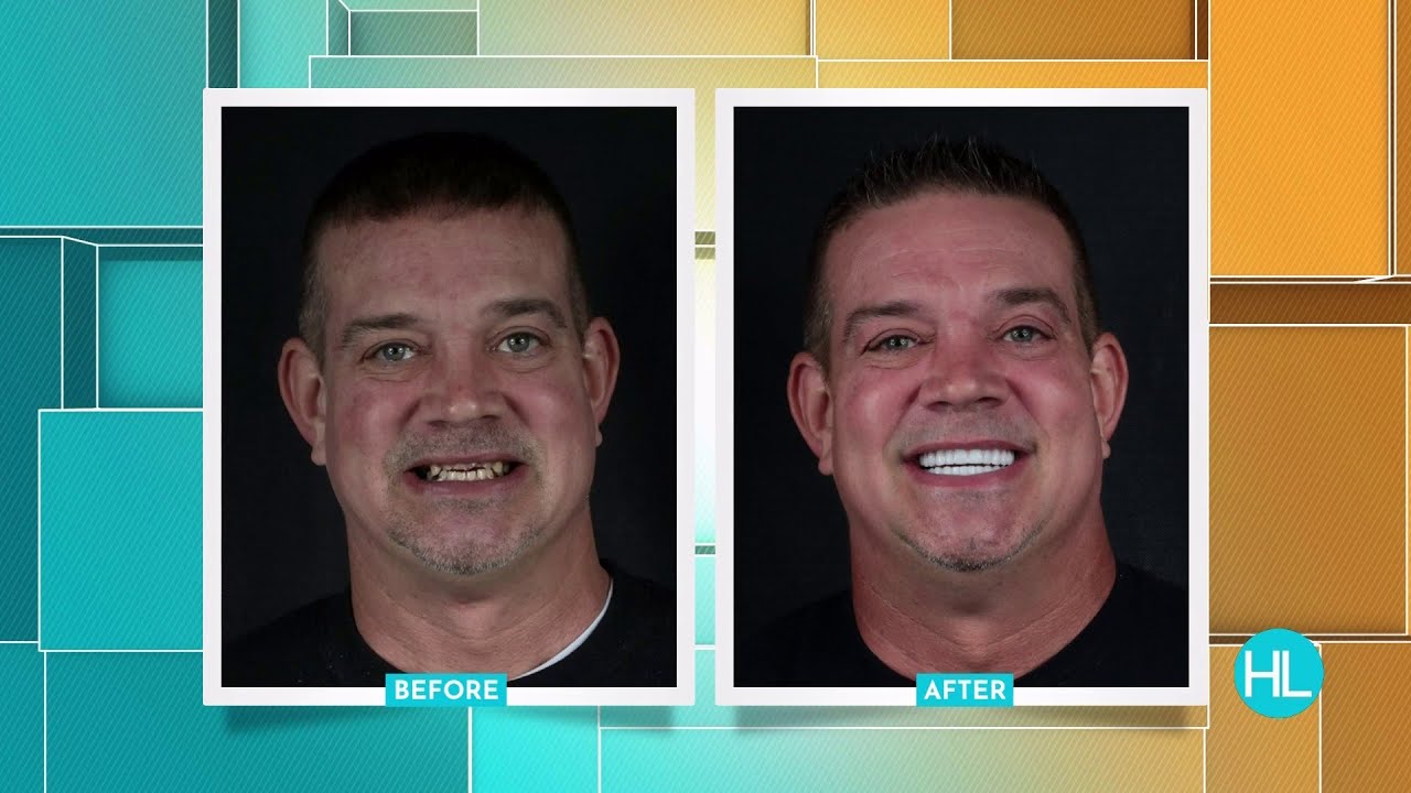 Stop hiding behind a bad smile with advanced dental implants