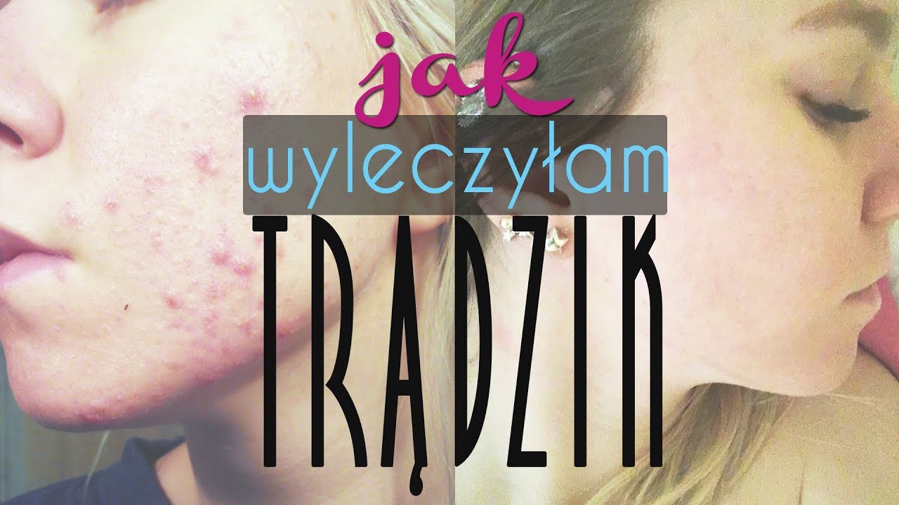Trądzik - leczenie izotekiem, moja historia i skutki uboczne 💪BIC&CYC❤