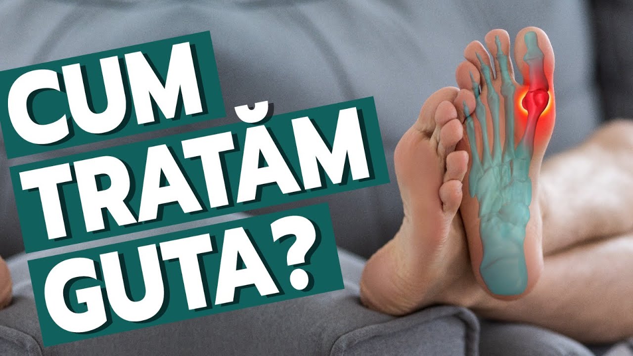 Dr. Daniela Nica: ce este guta, simptome, diagnostic și tratament în gută