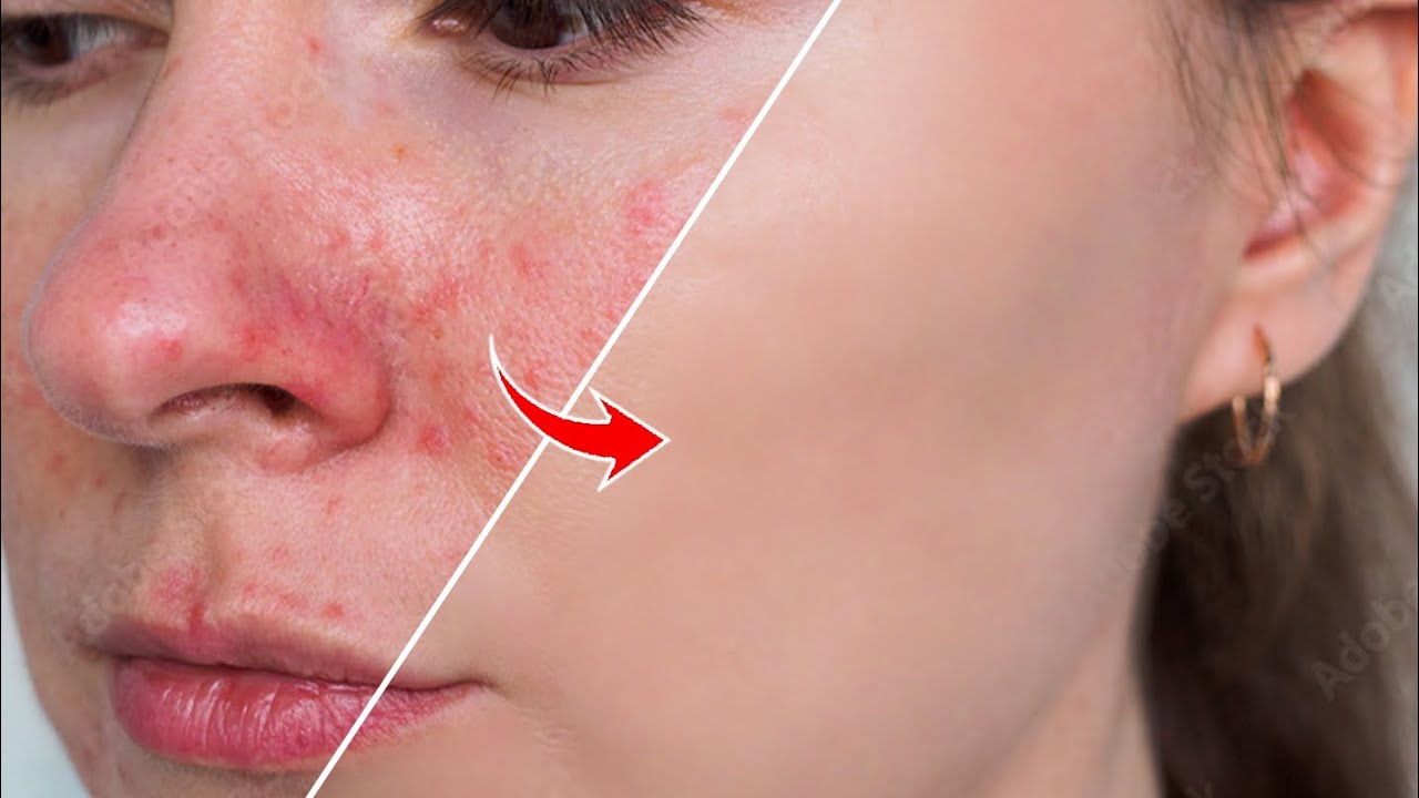 Master in Photoshop | How to remove the redness and acne using Photoshop