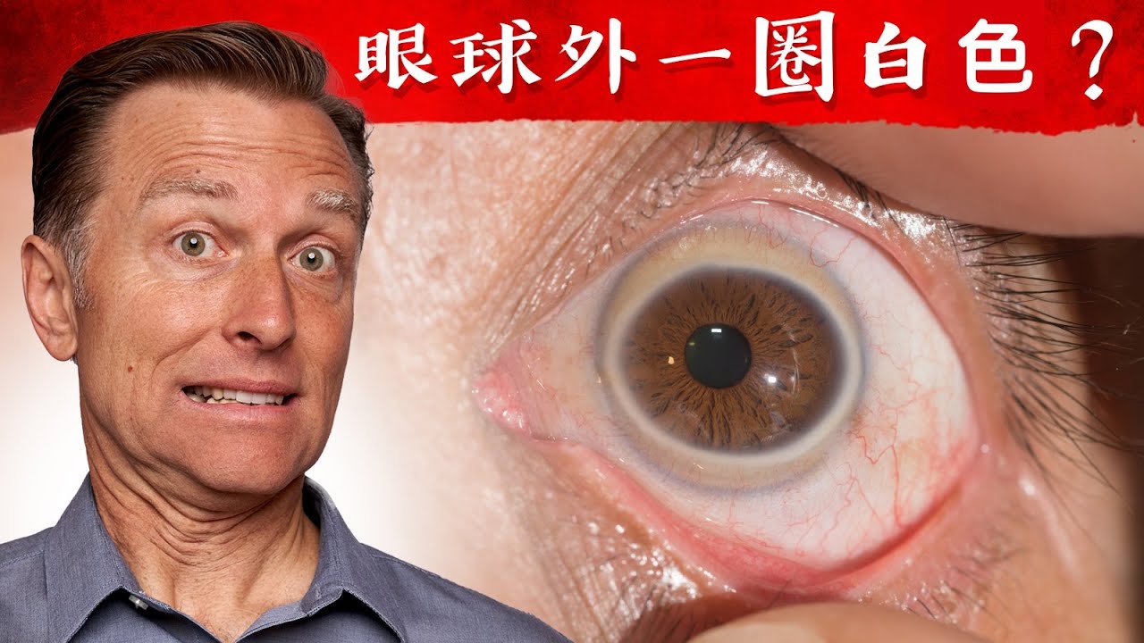 【眼睛】眼球外有一圈白色的？是什麼？自然療法,柏格醫生 Dr Berg
