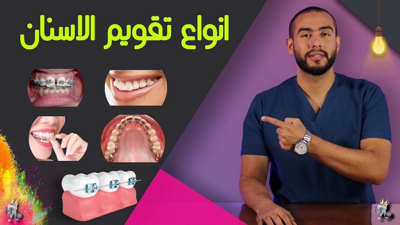 اختار نوع التقويم اللى يناسبك بنفسك قبل ماتروح للدكتور | انواع تقويم الاسنان ومميزات كل نوع بالاسعار