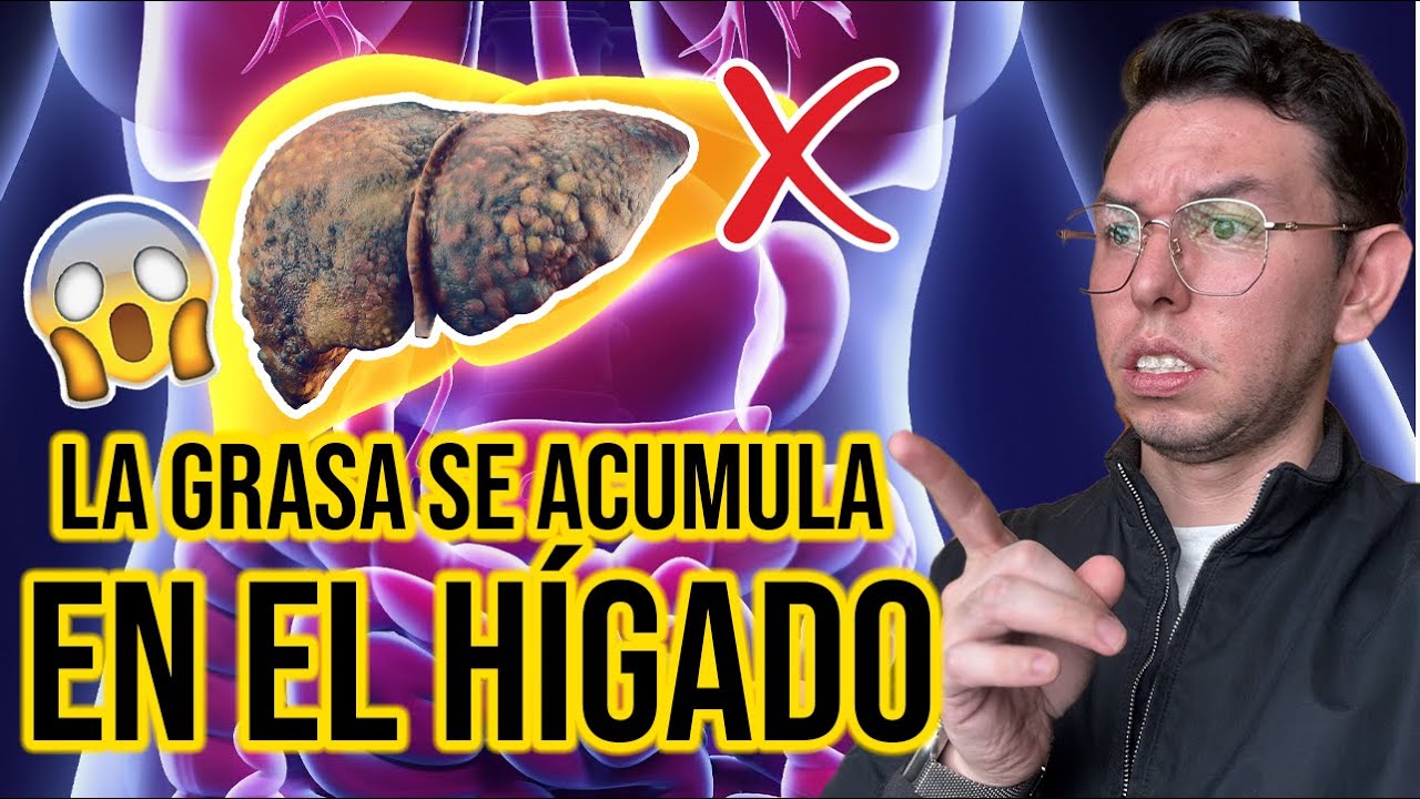 ¿Qué es HIGADO GRASO? MASLD | DrPoloGuerrero