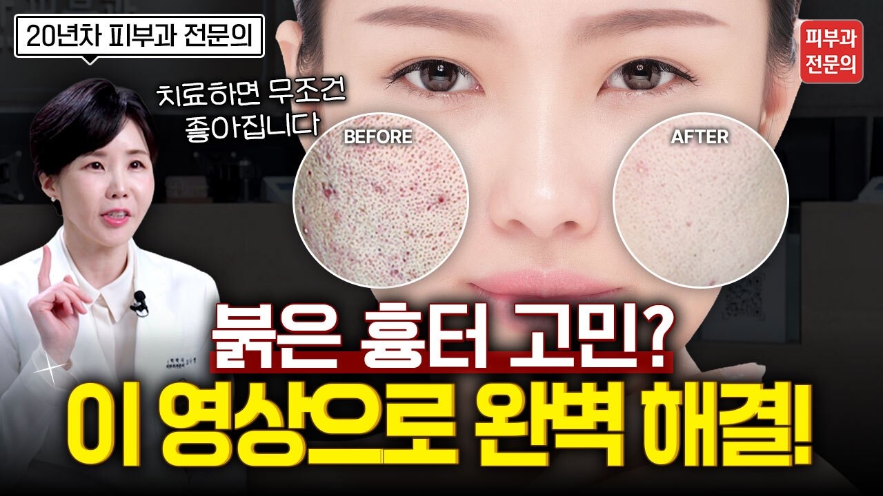 붉은흉터 없애는데 1등인 '브이빔 프리마' 소개해드립니다 [강서구피부과, 프리마피부과]