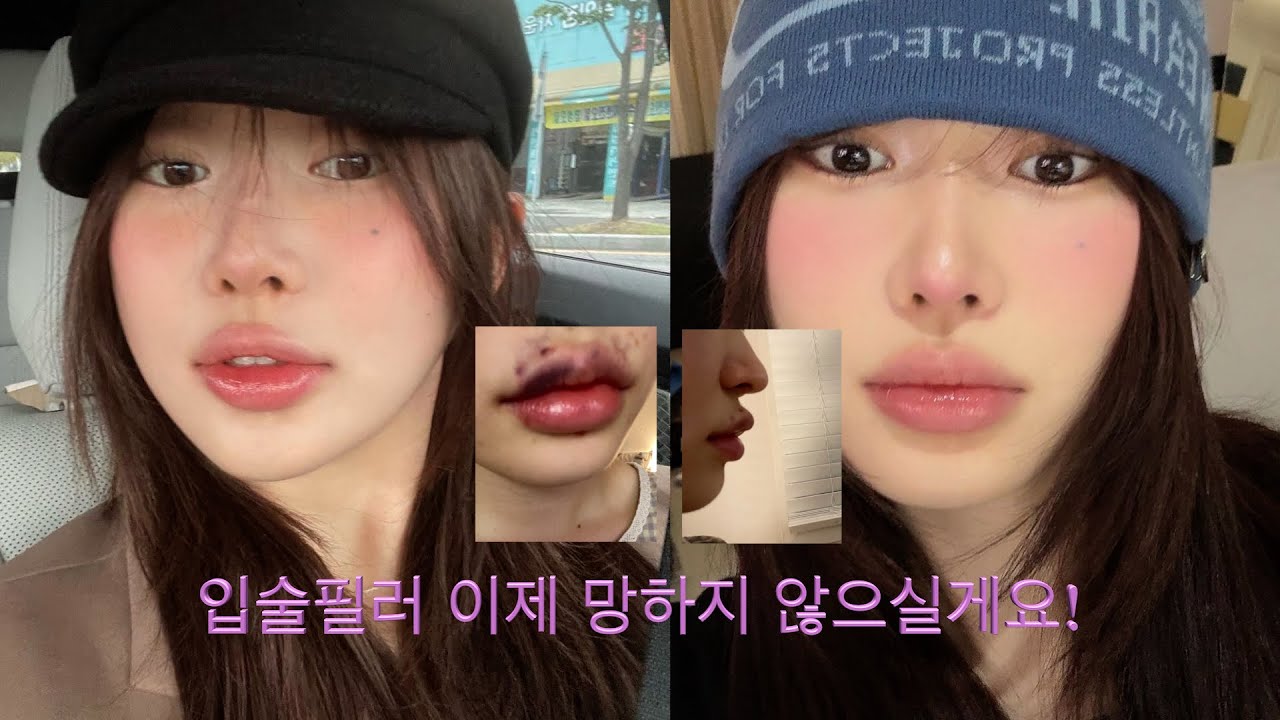 입술 칭찬 x10000번 들은 사람의 입술필러 이야기 👄