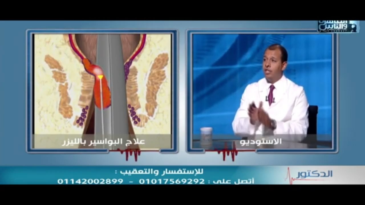 التطور الهائل في علاج البواسير بالليزر دون جراحة وبالبنج الموضعي | 2021