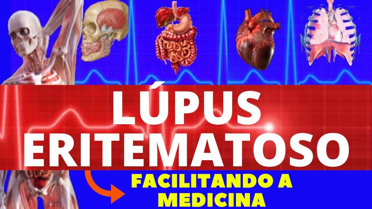 LÚPUS ERITEMATOSO - O QUE É, CAUSAS E SINTOMAS - TUDO SOBRE LÚPUS ERITEMATOSO - REUMATOLOGIA