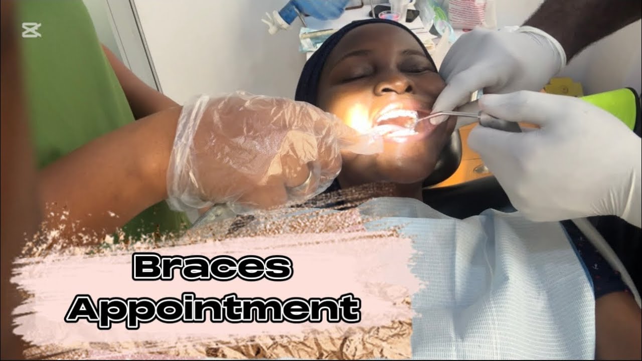 Braces Appointment | Adjustment of Arch-wires.