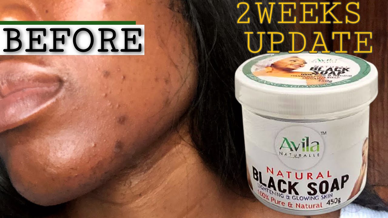 Avila naturalle blacksoap 2weeks review UPDATE.