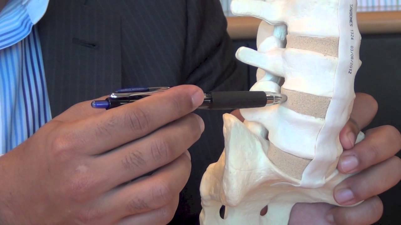 Extreme Lateral Interbody Fusion - Dr. Anuj Prasher | South Florida Orthopaedics