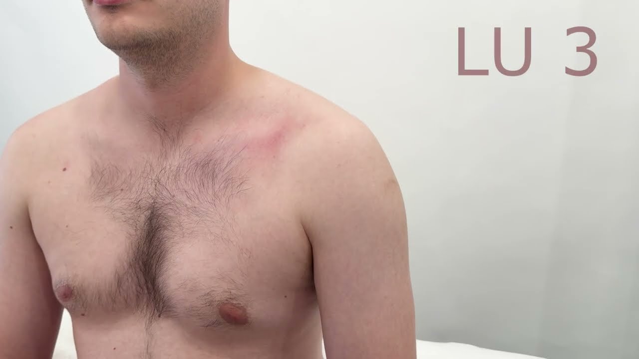 McMaster Medical Acupuncture Program: LU 3 Point Demonstration